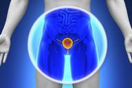 The micro-chip that detects prostate cancer