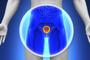 The micro-chip that detects prostate cancer